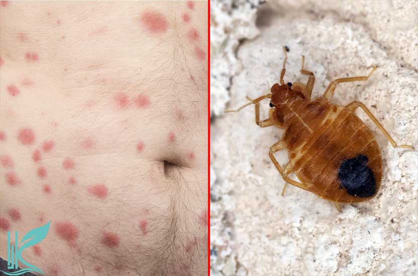 Bedbug bites